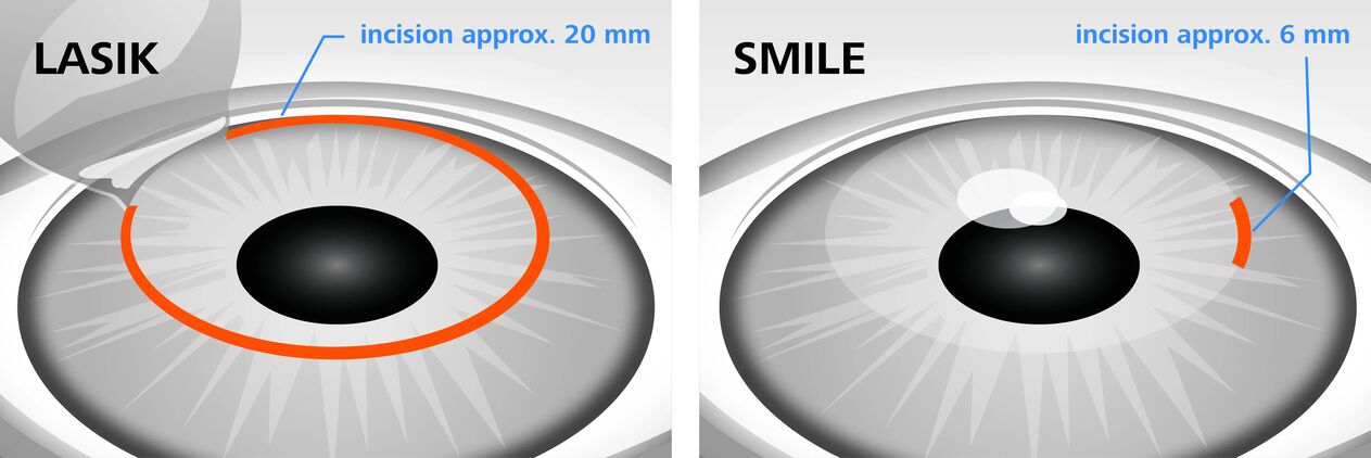 Comparación dos métodos de corrección da visión con láser LASIK e SMILE